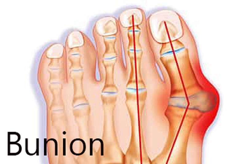 bunions - causes, symptoms and treatment