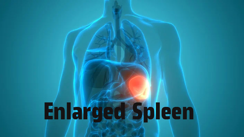 Enlarged Spleen Treating This Condition