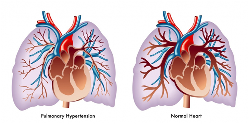 pulmonary hypertension disease