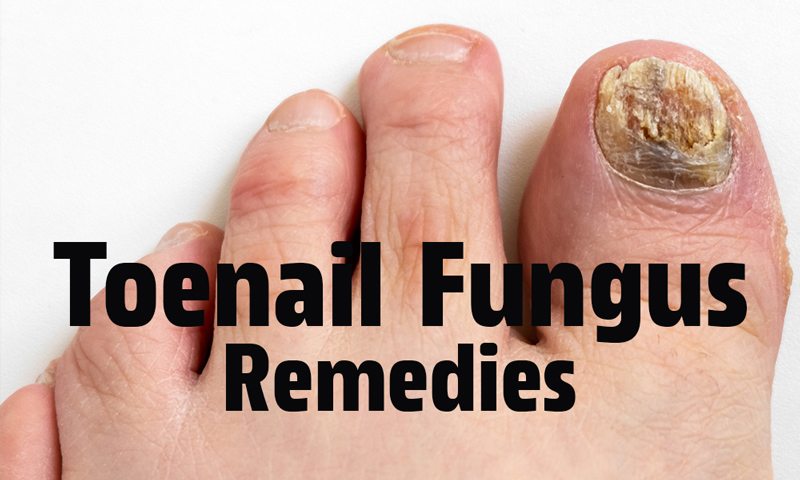 toenail fungus remedies